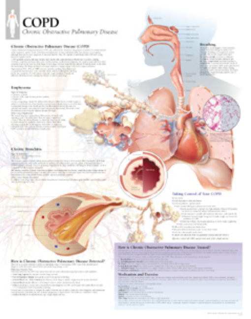 COPD (Chronic Obstructive Pulmonary Disease) Laminated Poster